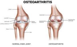 osteoachrities